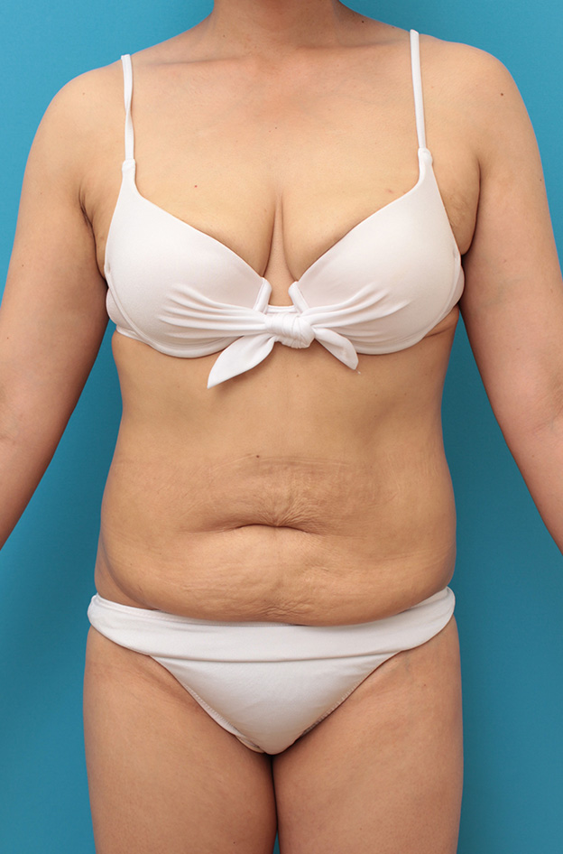腹リダクション（お腹のたるみ取り）,お腹のたるみ取り手術（腹部リダクション）の腫れが引いていく症例写真,手術前,mainpic_hara001a.jpg