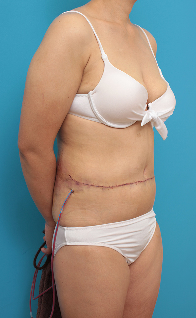 腹リダクション（お腹のたるみ取り）,お腹のたるみ取り手術（腹部リダクション）の腫れが引いていく症例写真,手術直後,mainpic_hara001g.jpg