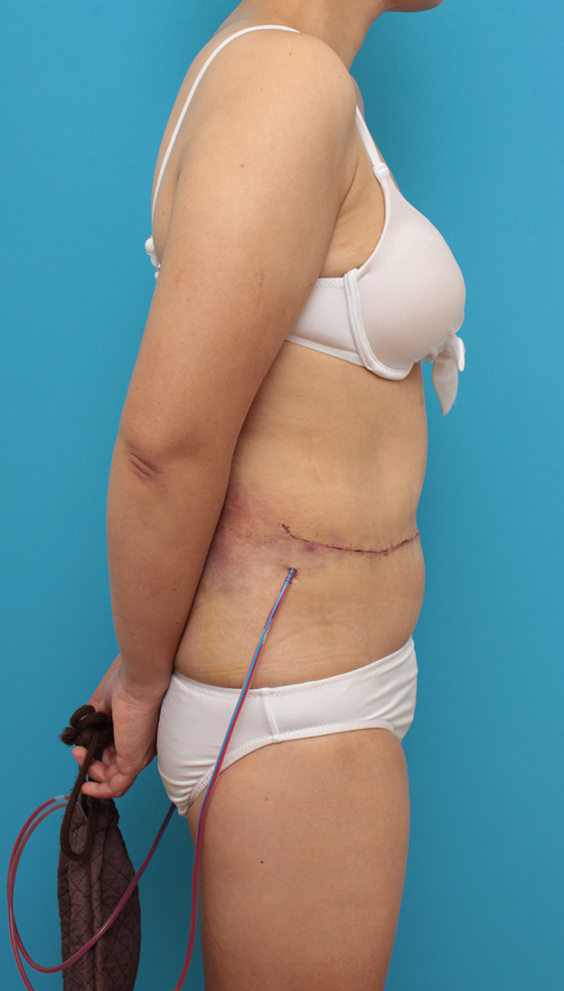 腹リダクション（お腹のたるみ取り）,お腹のたるみ取り手術（腹部リダクション）の腫れが引いていく症例写真,手術直後,mainpic_hara001l.jpg