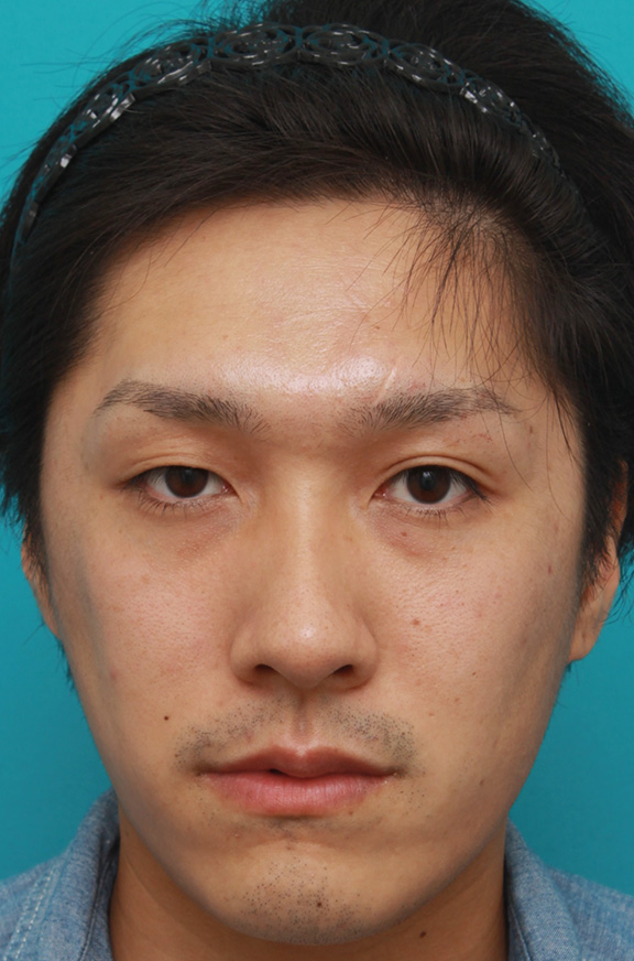 ボツリヌストキシン注射（エラ、プチ小顔術）,ボツリヌストキシン注射（エラ、プチ小顔術）で小顔になった20代後半の男性患者様の症例写真,After（1年3ヶ月後）,ba_botox_puchi026_b01.jpg