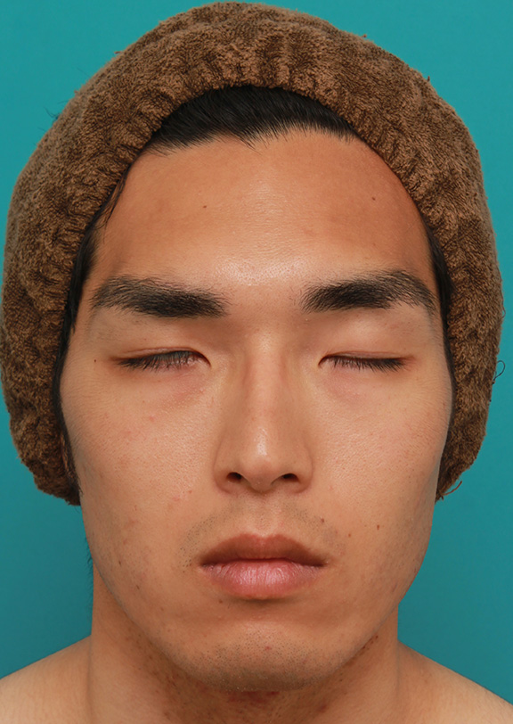 眼瞼下垂（がんけんかすい）,片目の先天性眼瞼下垂を筋膜吊り上げで手術した症例写真,After（6ヶ月後の目を閉じた状態）,