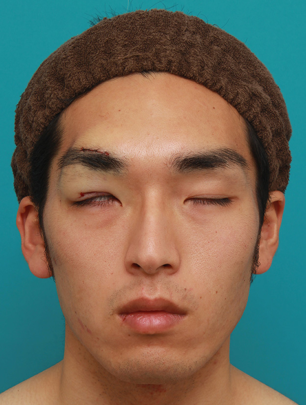 眼瞼下垂（がんけんかすい）,片目の先天性眼瞼下垂を筋膜吊り上げで手術した症例写真,手術直後,目を閉じた状態,mainpic_ganken033c.jpg
