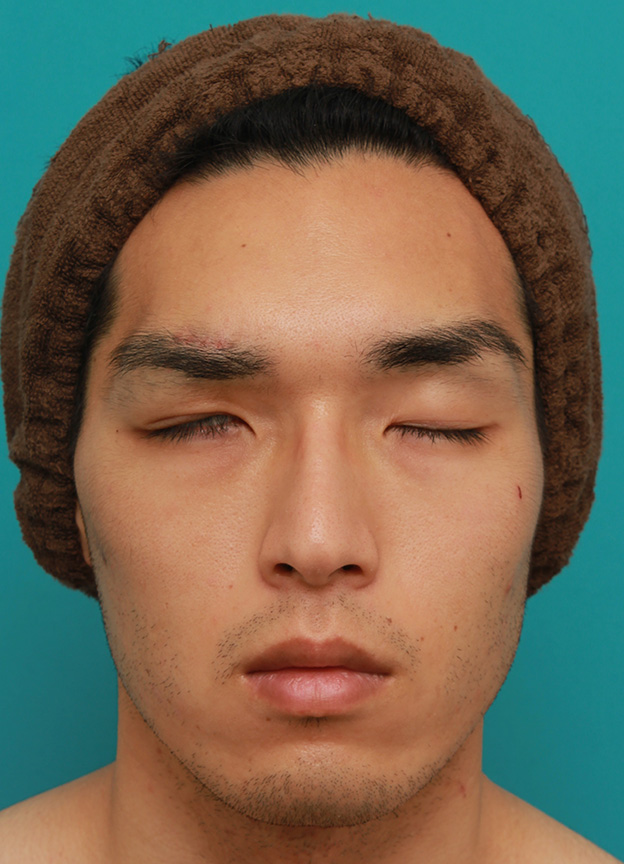 眼瞼下垂（がんけんかすい）,片目の先天性眼瞼下垂を筋膜吊り上げで手術した症例写真,1週間後,目を閉じた状態,mainpic_ganken033e.jpg