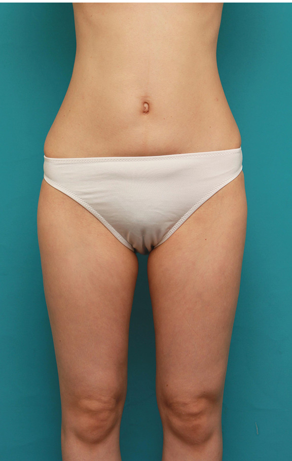 脂肪吸引,痩せている30代前半女性の太ももとお腹周りから脂肪吸引し、バストに脂肪注入した症例写真,After（6ヶ月後）,ba_shibokyuin028_b04.jpg