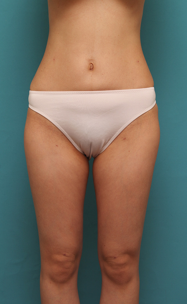 ピュアコンデンス脂肪注入豊胸,痩せている30代前半女性の太ももとお腹周りから脂肪吸引し、バストに脂肪注入した症例写真,1ヶ月後,mainpic_shibokyuin028d.jpg
