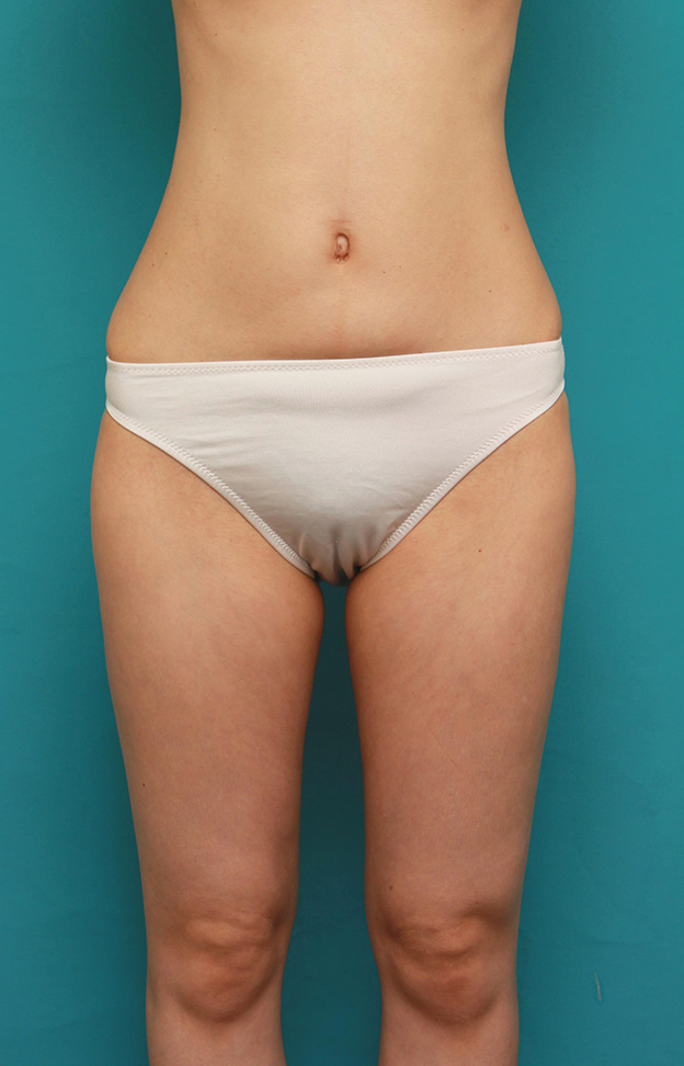 脂肪吸引,痩せている30代前半女性の太ももとお腹周りから脂肪吸引し、バストに脂肪注入した症例写真,6ヶ月後,mainpic_shibokyuin028e.jpg