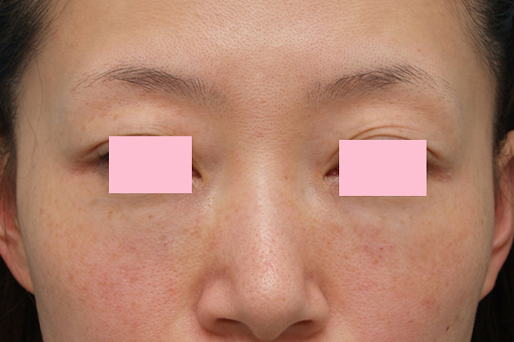 目の下のゴルゴ線をヒアルロン酸注射で改善させた症例写真,After（1週間後）,ba_golgo005_a01.jpg