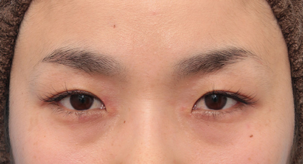 症例写真,目頭切開で蒙古襞の突っ張りをとり、目を内側に広げた30代女性の症例写真,手術前,mainpic_megashira049a.jpg