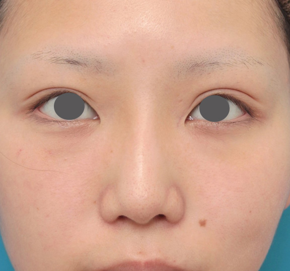 隆鼻術（シリコンプロテーゼ）,鼻のシリコンプロテーゼと小鼻（鼻翼）縮小手術を同時に行った症例写真,After（6ヶ月後）,ba_ryubi1039_b01.jpg