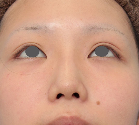隆鼻術（シリコンプロテーゼ）,鼻のシリコンプロテーゼと小鼻（鼻翼）縮小手術を同時に行った症例写真,After（6ヶ月後）,ba_ryubi1039_b02.jpg