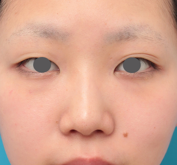 鼻翼縮小（小鼻縮小）,鼻のシリコンプロテーゼと小鼻（鼻翼）縮小手術を同時に行った症例写真,Before,ba_ryubi1039_b01.jpg