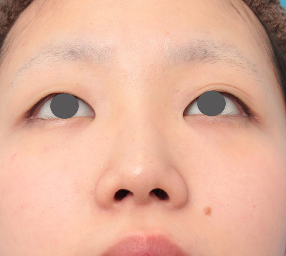 隆鼻術（シリコンプロテーゼ）,鼻のシリコンプロテーゼと小鼻（鼻翼）縮小手術を同時に行った症例写真,Before,ba_ryubi1039_b02.jpg