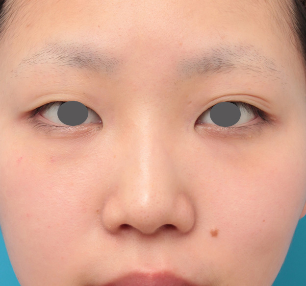 鼻翼縮小（小鼻縮小）,鼻のシリコンプロテーゼと小鼻（鼻翼）縮小手術を同時に行った症例写真,手術前,mainpic_ryubi1039a.jpg