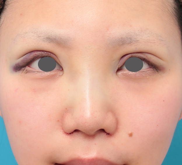 隆鼻術（シリコンプロテーゼ）,鼻のシリコンプロテーゼと小鼻（鼻翼）縮小手術を同時に行った症例写真,手術直後,mainpic_ryubi1039b.jpg