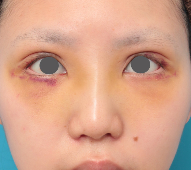 隆鼻術（シリコンプロテーゼ）,鼻のシリコンプロテーゼと小鼻（鼻翼）縮小手術を同時に行った症例写真,1週間後,mainpic_ryubi1039c.jpg
