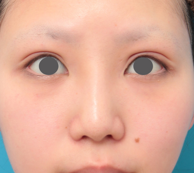 隆鼻術（シリコンプロテーゼ）,鼻のシリコンプロテーゼと小鼻（鼻翼）縮小手術を同時に行った症例写真,3週間後,mainpic_ryubi1039d.jpg