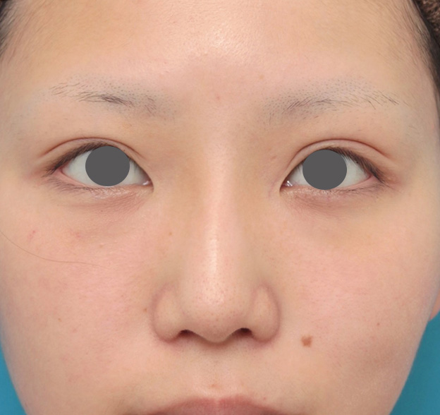 鼻翼縮小（小鼻縮小）,鼻のシリコンプロテーゼと小鼻（鼻翼）縮小手術を同時に行った症例写真,6ヶ月後,mainpic_ryubi1039e.jpg