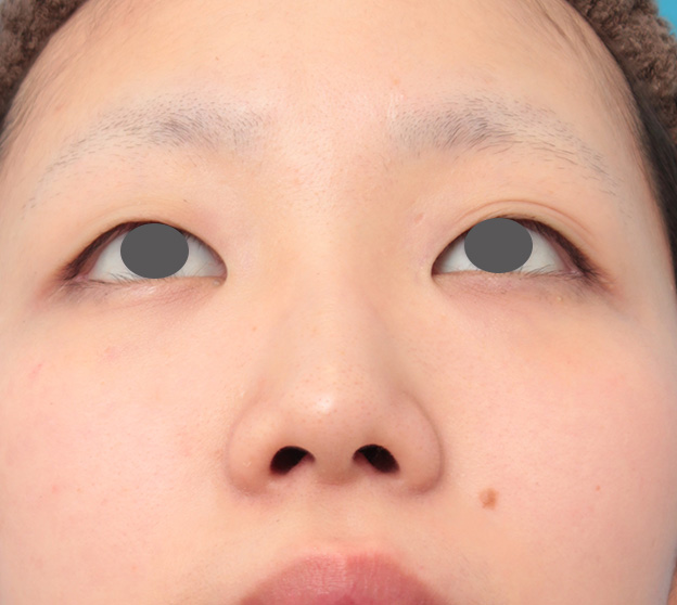 隆鼻術（シリコンプロテーゼ）,鼻のシリコンプロテーゼと小鼻（鼻翼）縮小手術を同時に行った症例写真,手術前,mainpic_ryubi1039f.jpg