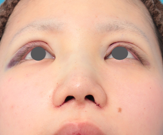 鼻翼縮小（小鼻縮小）,鼻のシリコンプロテーゼと小鼻（鼻翼）縮小手術を同時に行った症例写真,手術直後,mainpic_ryubi1039g.jpg