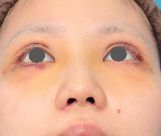 隆鼻術（シリコンプロテーゼ）,鼻のシリコンプロテーゼと小鼻（鼻翼）縮小手術を同時に行った症例写真,1週間後,mainpic_ryubi1039h.jpg
