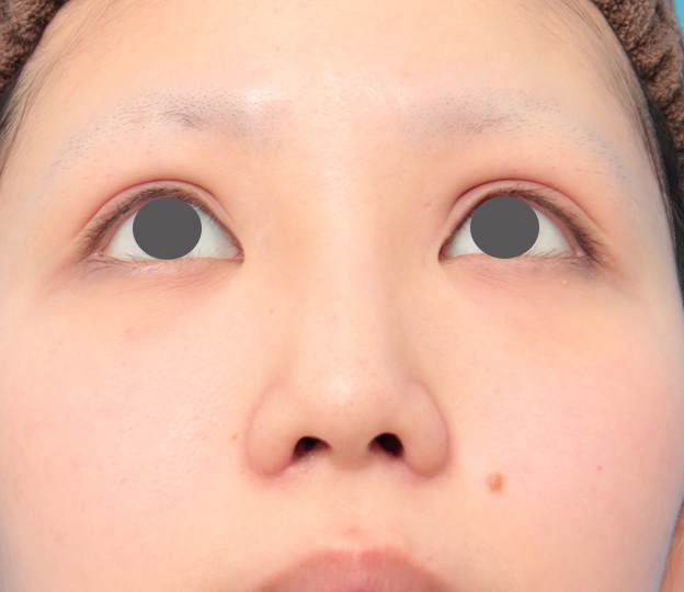 鼻翼縮小（小鼻縮小）,鼻のシリコンプロテーゼと小鼻（鼻翼）縮小手術を同時に行った症例写真,3週間後,mainpic_ryubi1039i.jpg
