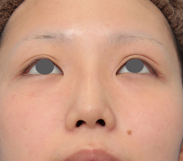 鼻翼縮小（小鼻縮小）,鼻のシリコンプロテーゼと小鼻（鼻翼）縮小手術を同時に行った症例写真,6ヶ月後,mainpic_ryubi1039j.jpg