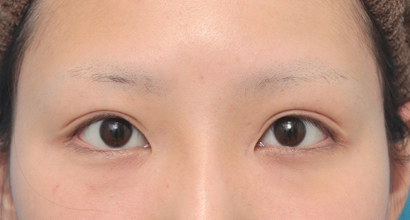 眼瞼下垂（がんけんかすい）,眼瞼下垂手術で平行型二重を作った症例写真,After（6ヶ月後）,ba_ganken034_b01.jpg