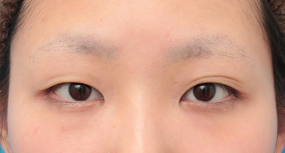 眼瞼下垂（がんけんかすい）,眼瞼下垂手術で平行型二重を作った症例写真,Before,ba_ganken034_b01.jpg