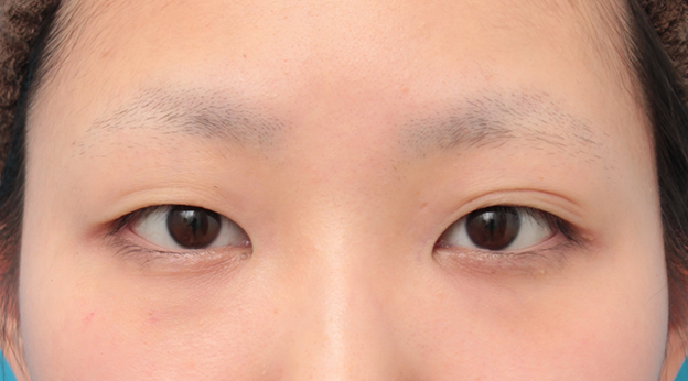 眼瞼下垂（がんけんかすい）,眼瞼下垂手術で平行型二重を作った症例写真,手術前,mainpic_ganken034a.jpg