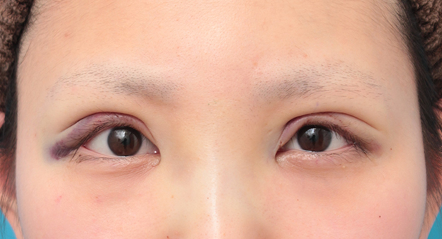 眼瞼下垂（がんけんかすい）,眼瞼下垂手術で平行型二重を作った症例写真,手術直後,mainpic_ganken034b.jpg