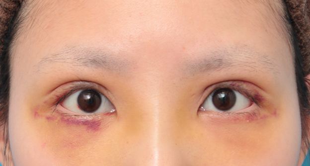眼瞼下垂（がんけんかすい）,眼瞼下垂手術で平行型二重を作った症例写真,6日後,mainpic_ganken034c.jpg