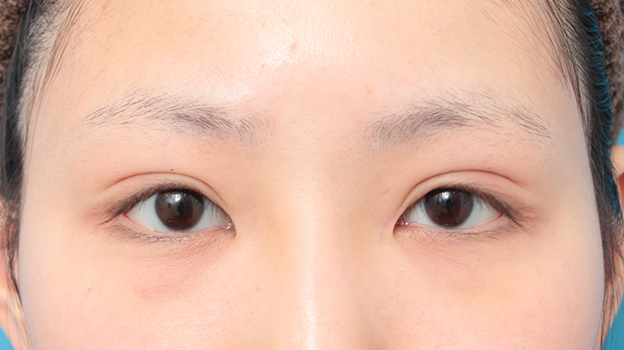 眼瞼下垂（がんけんかすい）,眼瞼下垂手術で平行型二重を作った症例写真,3週間後,mainpic_ganken034d.jpg