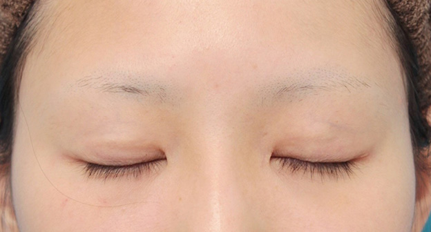 眼瞼下垂（がんけんかすい）,眼瞼下垂手術で平行型二重を作った症例写真,6ヶ月後,目を閉じた状態,mainpic_ganken034f.jpg