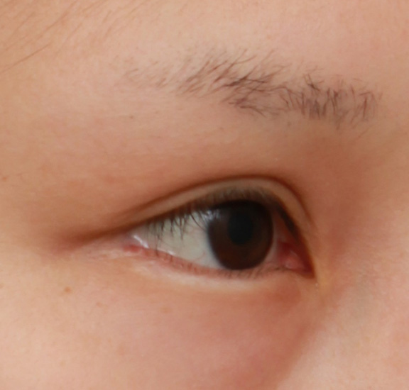 逆さまつ毛修正,下まぶたの逆さまつ毛の修正手術の症例写真,Before,ba_trichiasis001_b02.jpg