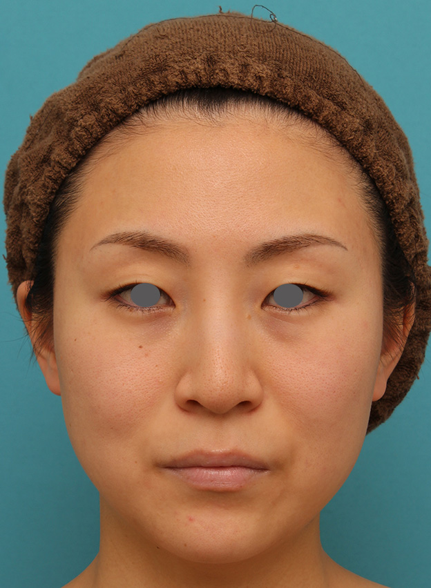 症例写真,下がっている口角を上げるボツリヌストキシン注射の症例写真,注射前,mainpic_lipsup_botox005a.jpg
