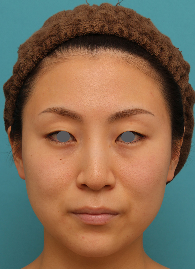 症例写真,下がっている口角を上げるボツリヌストキシン注射の症例写真,注射直後,mainpic_lipsup_botox005b.jpg