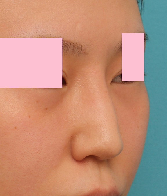 鼻翼縮小（小鼻縮小）,小鼻（鼻翼）縮小手術と鼻先の耳介軟骨移植を同時に行った20代女性の症例写真,After,ba_jikai035_b02.jpg