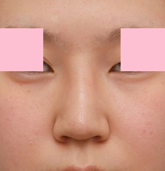 耳介軟骨移植（鼻先を出す）,小鼻（鼻翼）縮小手術と鼻先の耳介軟骨移植を同時に行った20代女性の症例写真,Before,ba_jikai035_b01.jpg