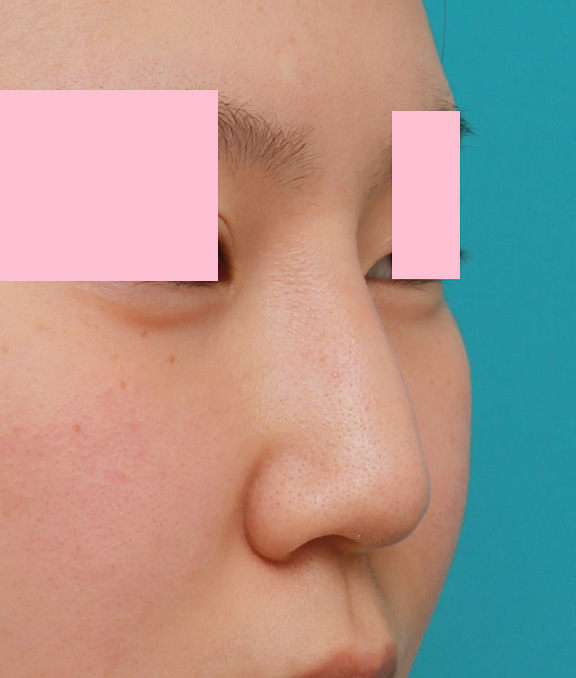 耳介軟骨移植（鼻先を出す）,小鼻（鼻翼）縮小手術と鼻先の耳介軟骨移植を同時に行った20代女性の症例写真,Before,ba_jikai035_b02.jpg