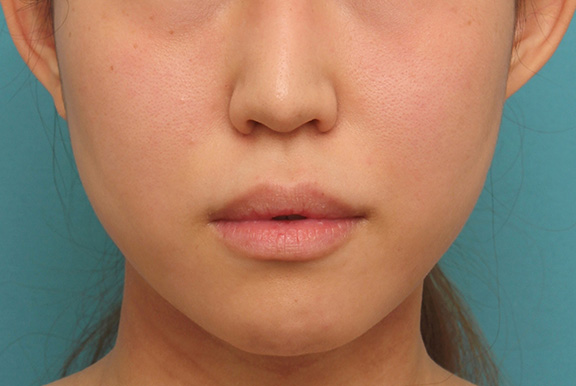 ヒアルロン酸で唇を厚く（ふっくら・アヒル口etc）,ヒアルロン酸注射でぷっくり厚いセクシーな唇になった20代女性の症例写真,After,ba_atsuku014_a01.jpg