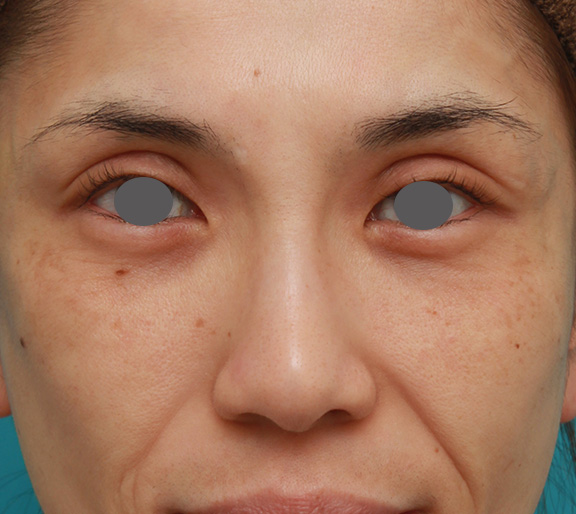 隆鼻注射（ヒアルロン酸注射）,患者様の希望で眉間から鼻根部にかけてヒアルロン酸を注射し、ギリシャ人のようになった症例写真,After（1ヶ月後）,ba_ryubi2028_a01.jpg