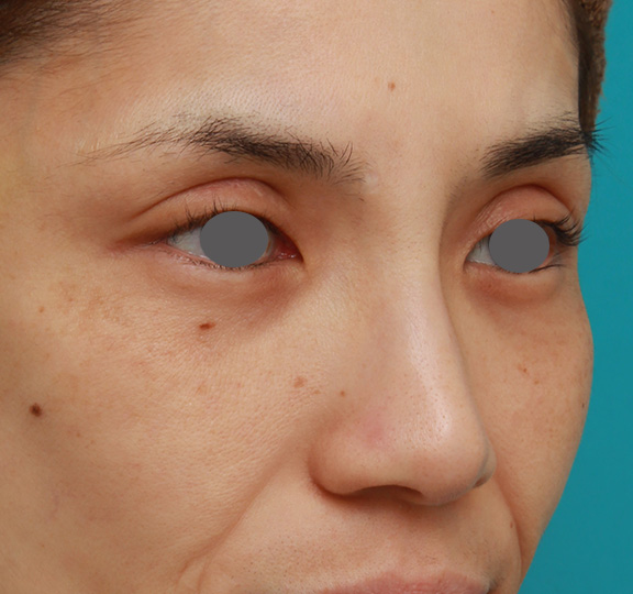 隆鼻注射（ヒアルロン酸注射）,患者様の希望で眉間から鼻根部にかけてヒアルロン酸を注射し、ギリシャ人のようになった症例写真,After（1ヶ月後）,ba_ryubi2028_b02.jpg