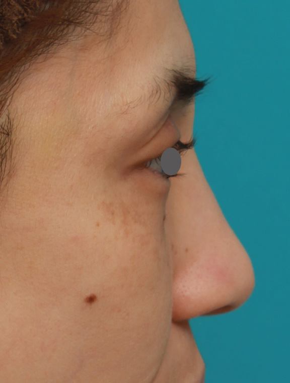隆鼻注射（ヒアルロン酸注射）,患者様の希望で眉間から鼻根部にかけてヒアルロン酸を注射し、ギリシャ人のようになった症例写真,After（1ヶ月後）,ba_ryubi2028_b03.jpg