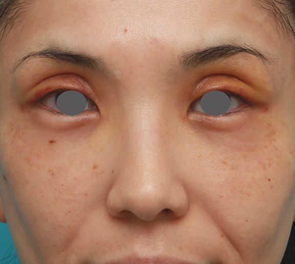 患者様の希望で眉間から鼻根部にかけてヒアルロン酸を注射し、ギリシャ人のようになった症例写真,Before,ba_ryubi2028_b01.jpg