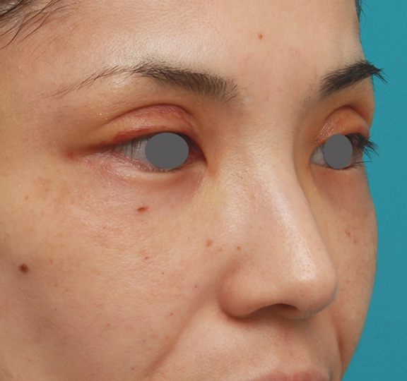 隆鼻注射（ヒアルロン酸注射）,患者様の希望で眉間から鼻根部にかけてヒアルロン酸を注射し、ギリシャ人のようになった症例写真,Before,ba_ryubi2028_b02.jpg