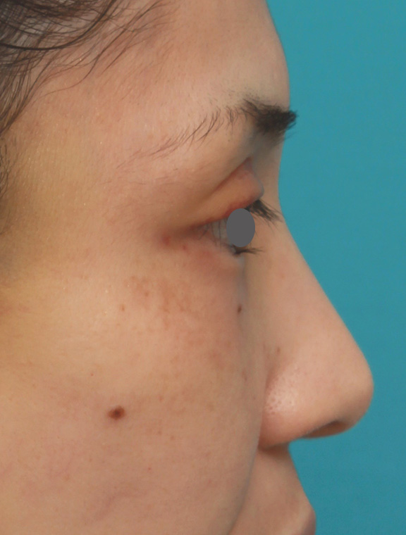 隆鼻注射（ヒアルロン酸注射）,患者様の希望で眉間から鼻根部にかけてヒアルロン酸を注射し、ギリシャ人のようになった症例写真,Before,ba_ryubi2028_b03.jpg