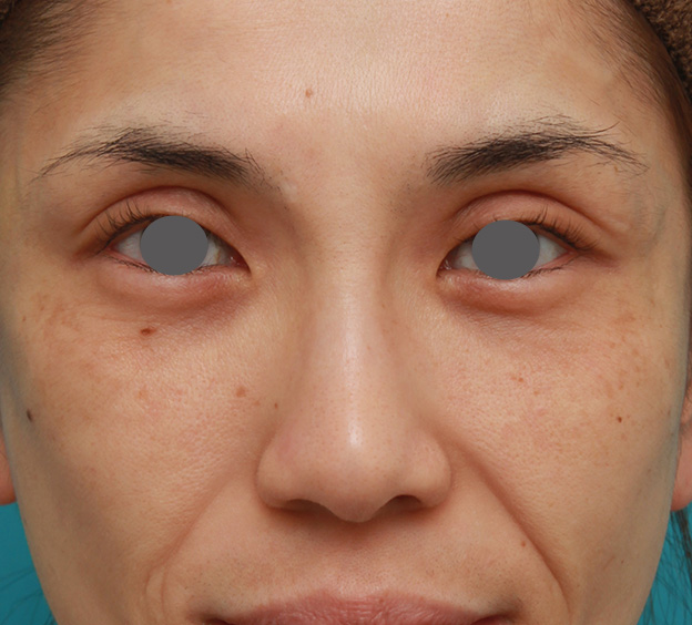 隆鼻注射（ヒアルロン酸注射）,患者様の希望で眉間から鼻根部にかけてヒアルロン酸を注射し、ギリシャ人のようになった症例写真,1ヶ月後,mainpic_ryubi2028c.jpg