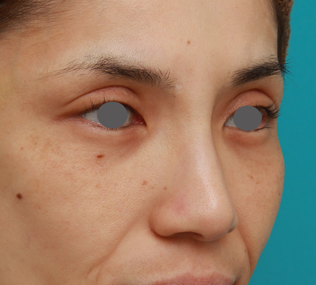 隆鼻注射（ヒアルロン酸注射）,患者様の希望で眉間から鼻根部にかけてヒアルロン酸を注射し、ギリシャ人のようになった症例写真,1ヶ月後,mainpic_ryubi2028f.jpg