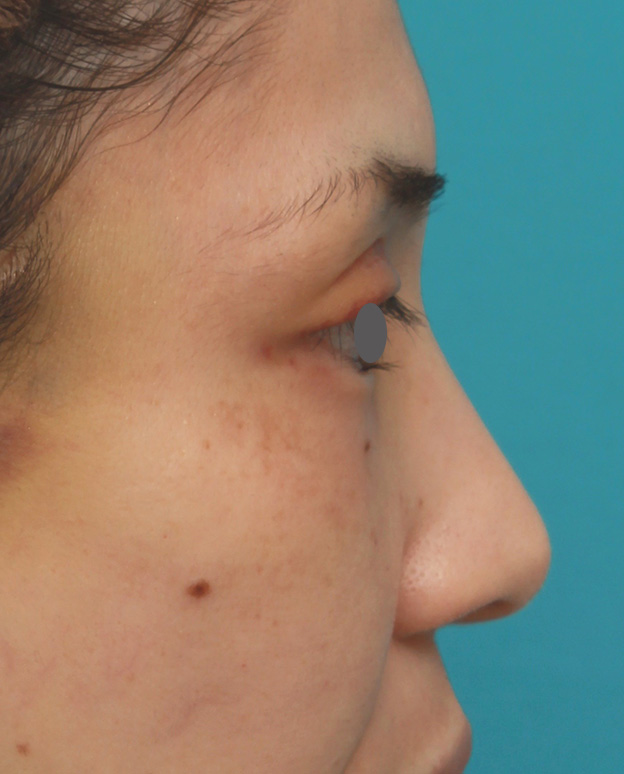 隆鼻注射（ヒアルロン酸注射）,患者様の希望で眉間から鼻根部にかけてヒアルロン酸を注射し、ギリシャ人のようになった症例写真,注射前,mainpic_ryubi2028g.jpg