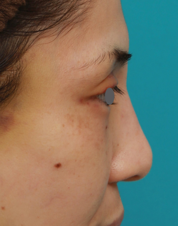 隆鼻注射（ヒアルロン酸注射）,患者様の希望で眉間から鼻根部にかけてヒアルロン酸を注射し、ギリシャ人のようになった症例写真,注射直後,mainpic_ryubi2028h.jpg